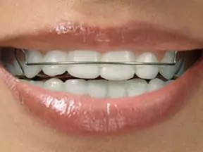 steel braces