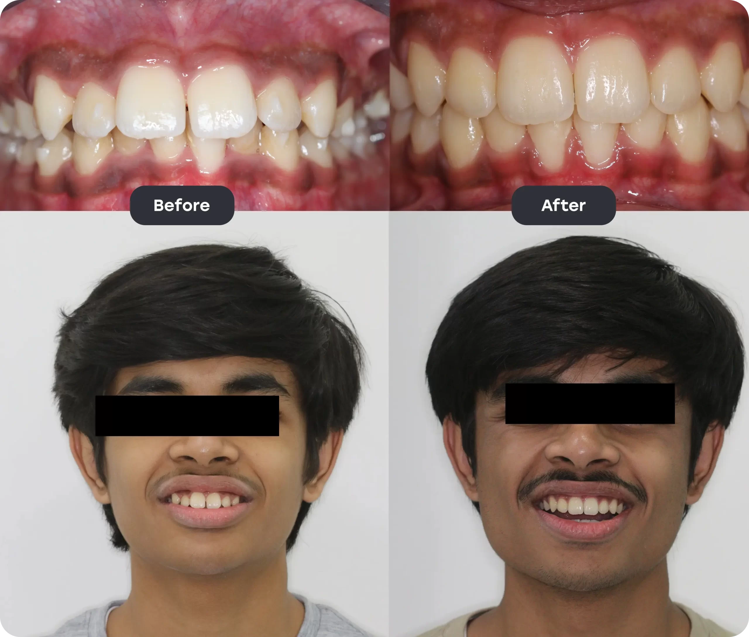 Before and After