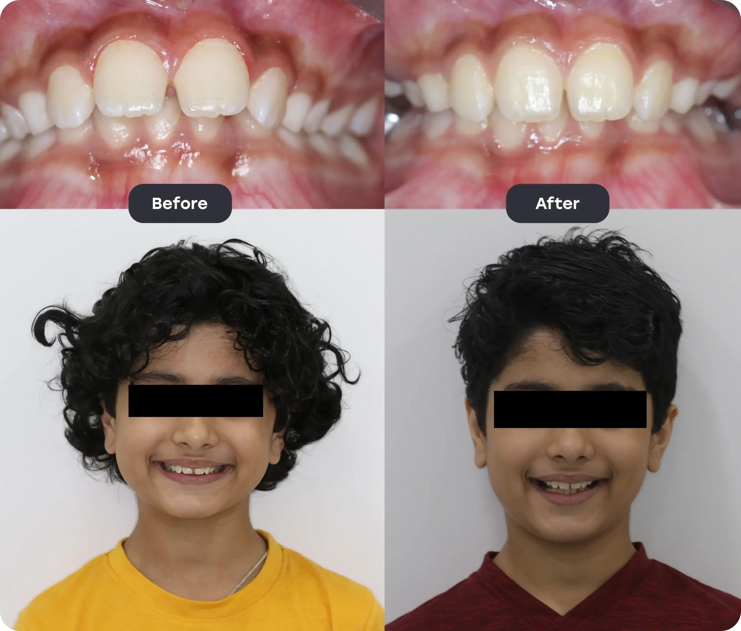 Before and After