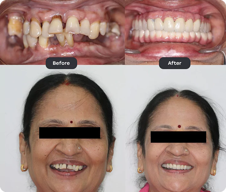 Before and After