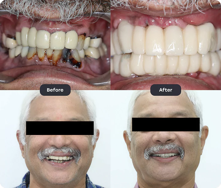 Before and After
