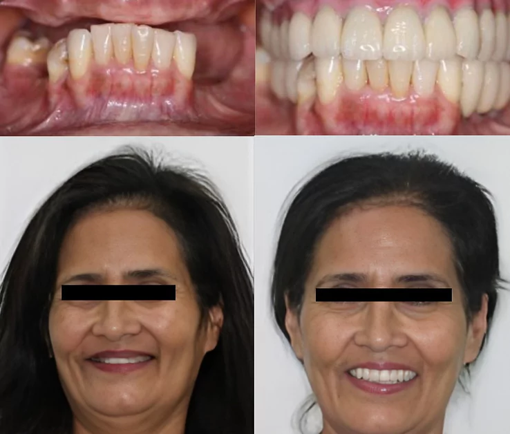 Before and After