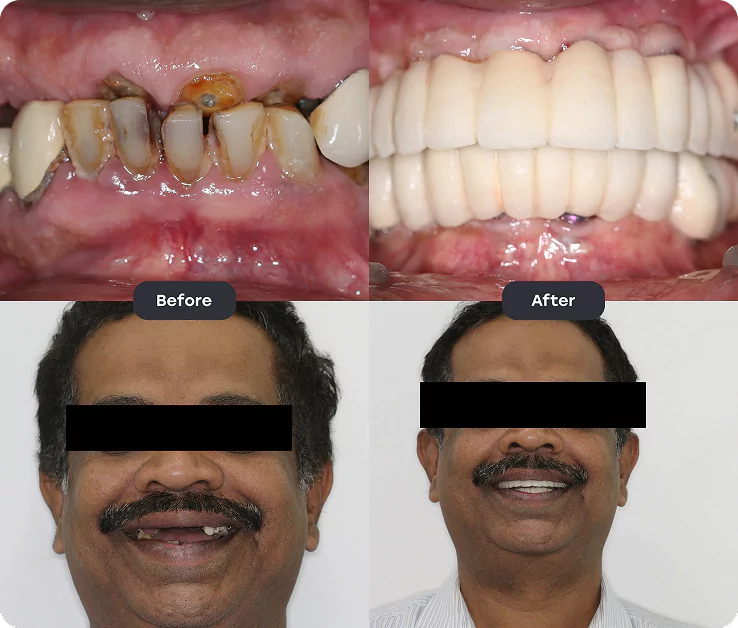 Before and After