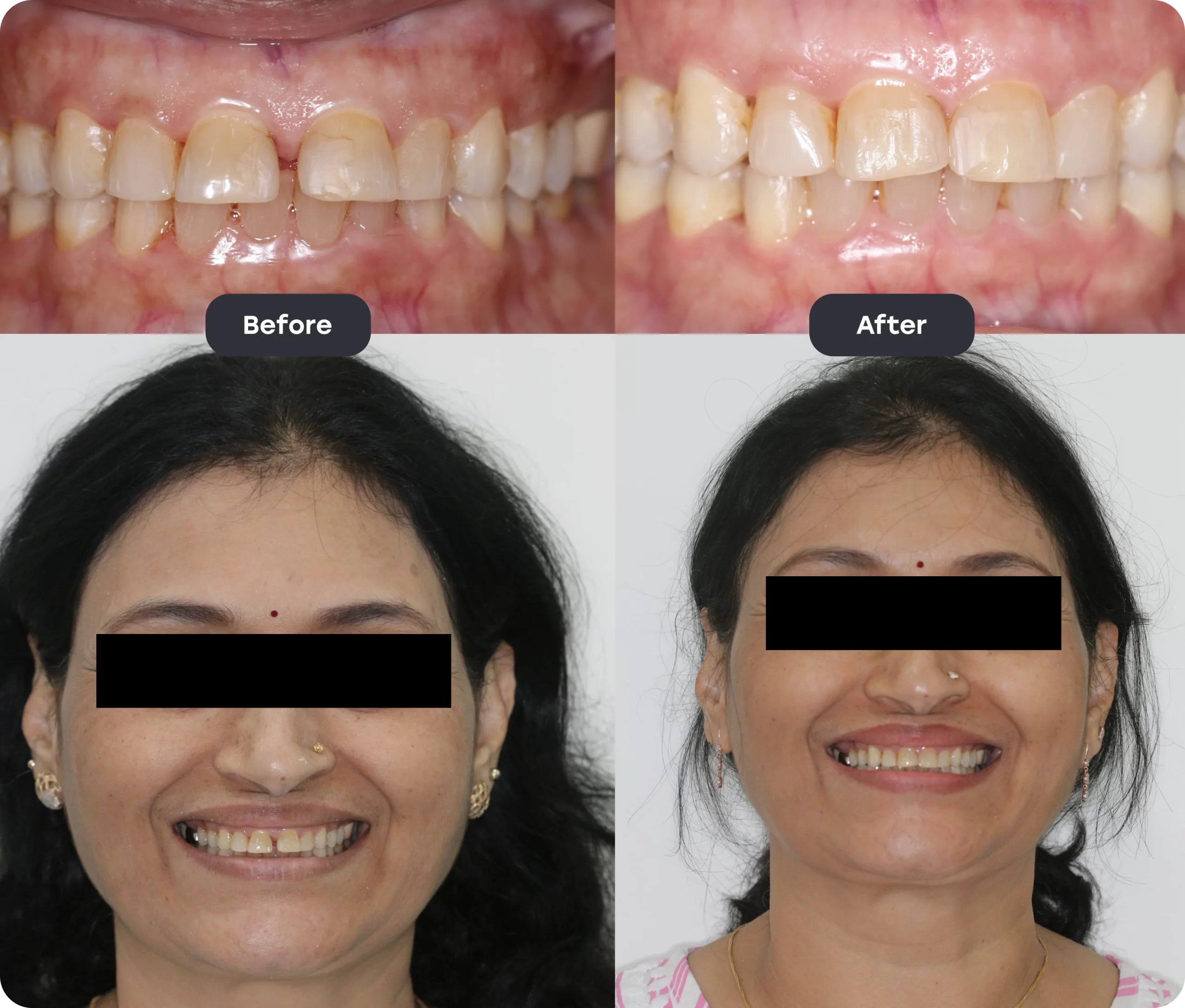 Before and After