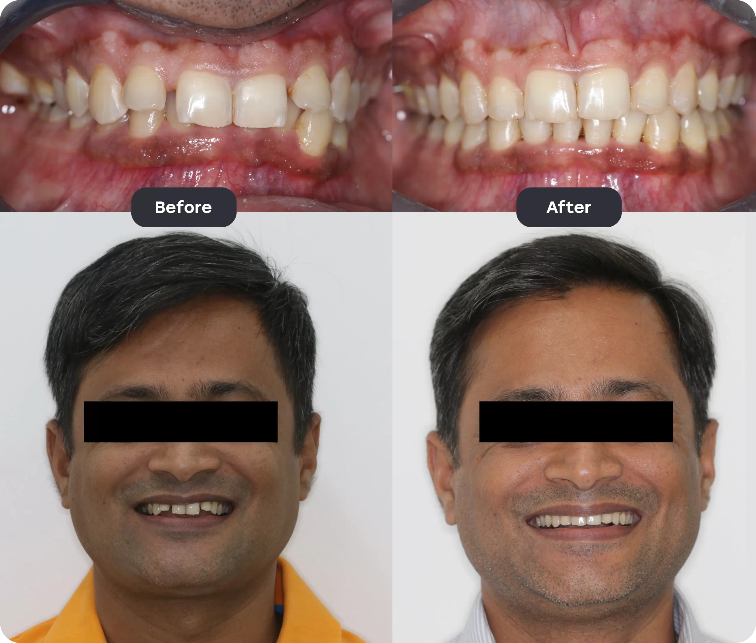 Before and After