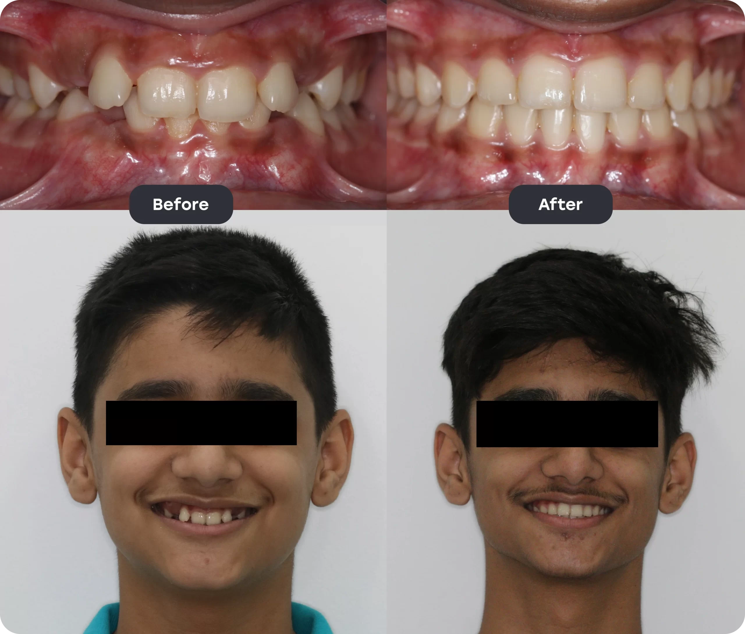 Before and After