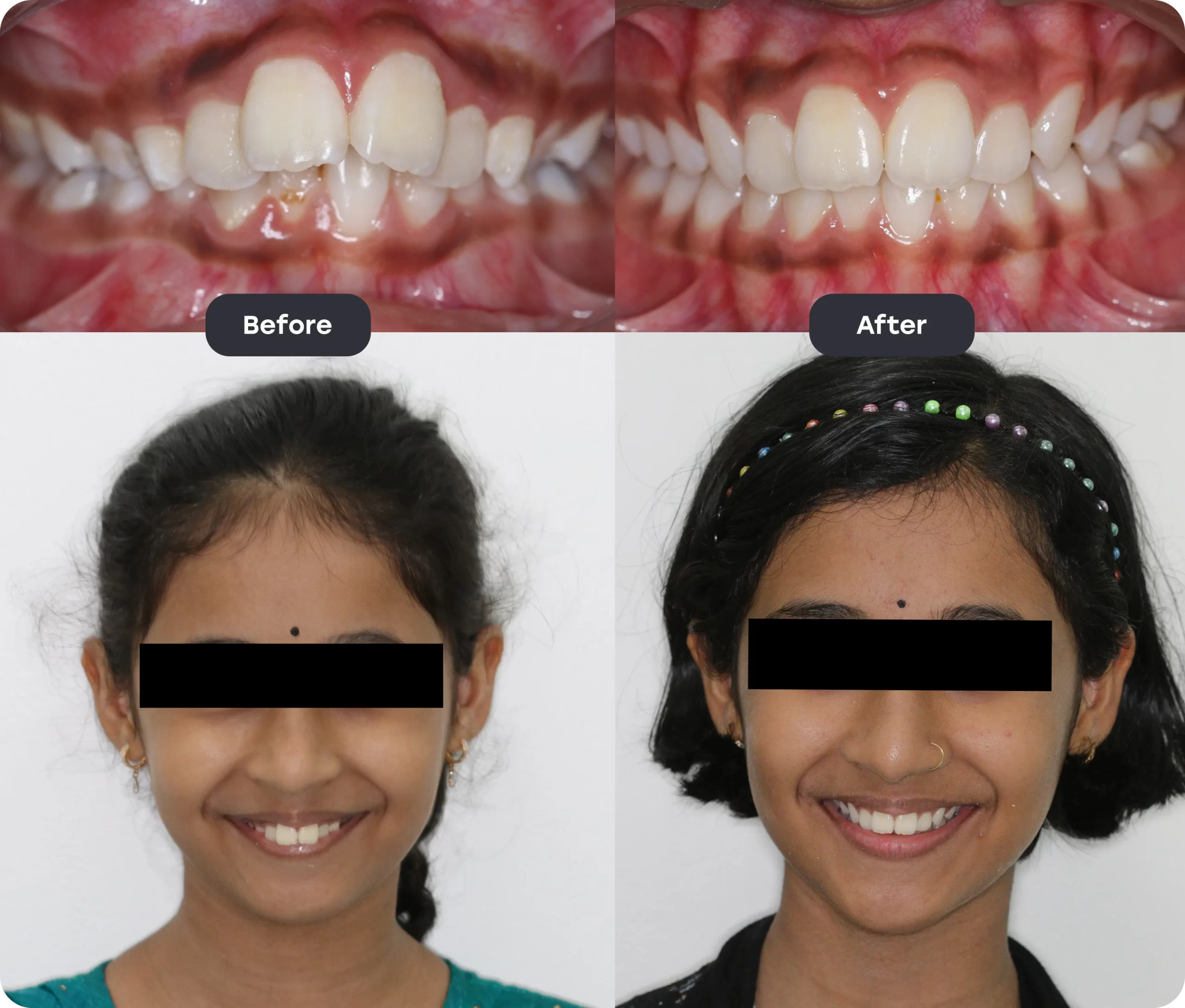 Before and After
