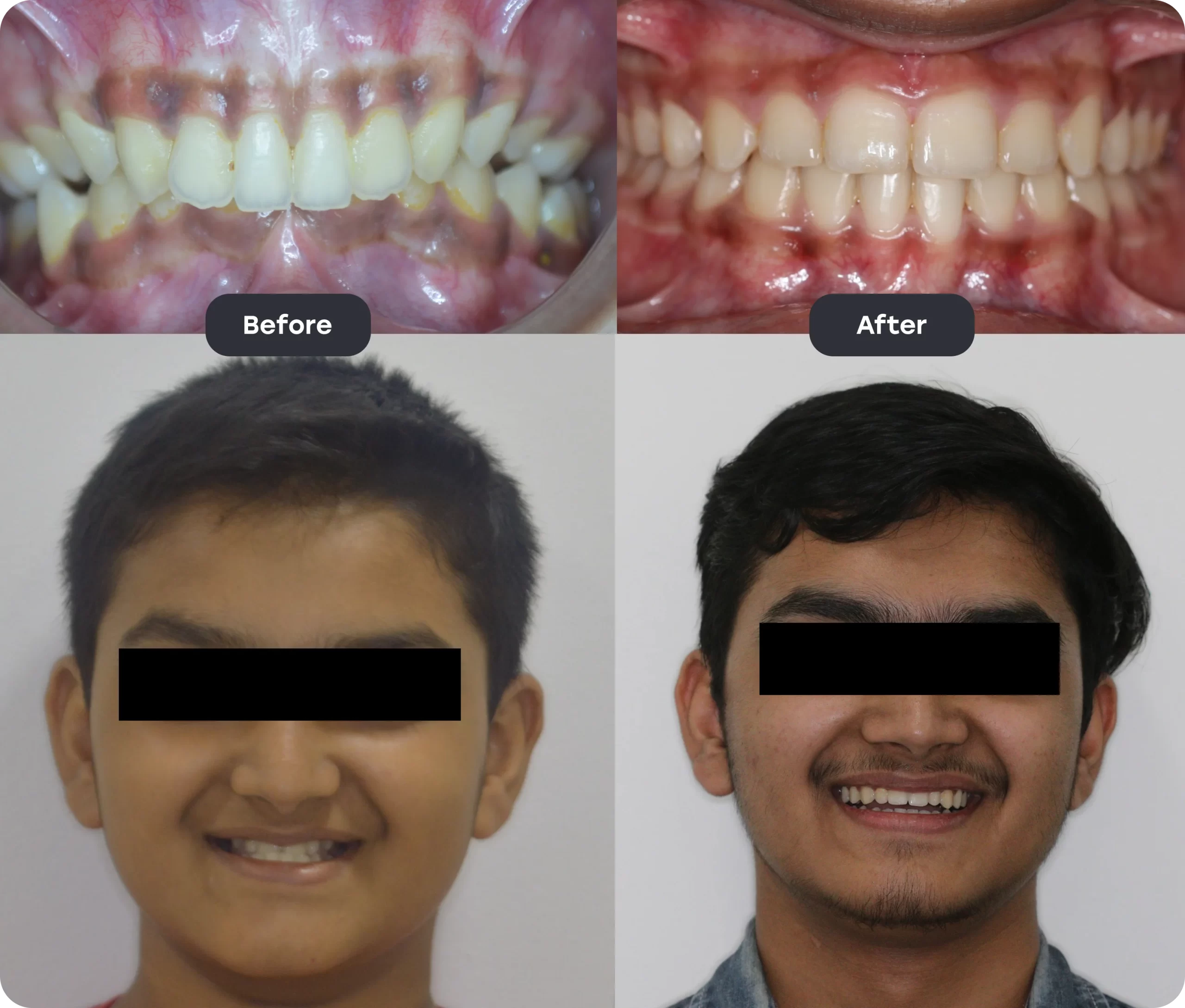 Before and After