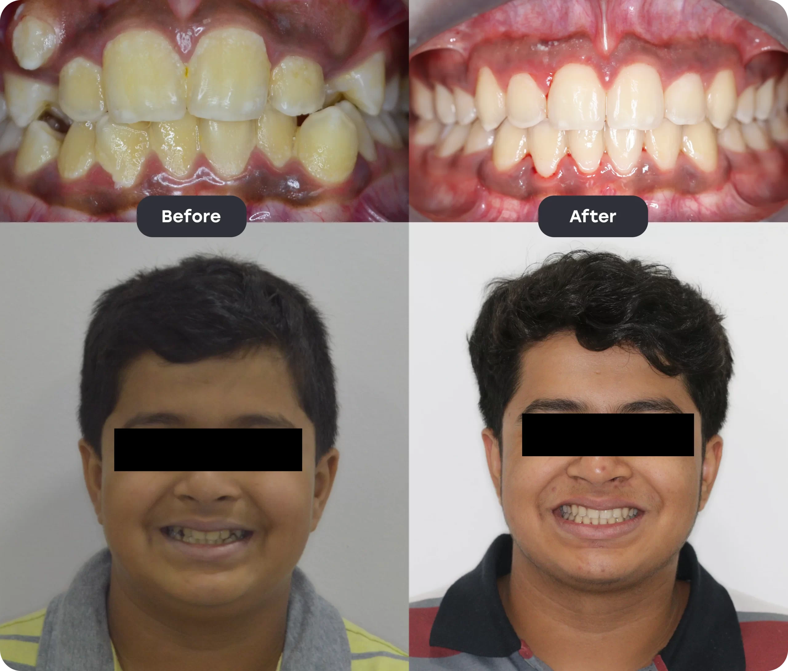 Before and After
