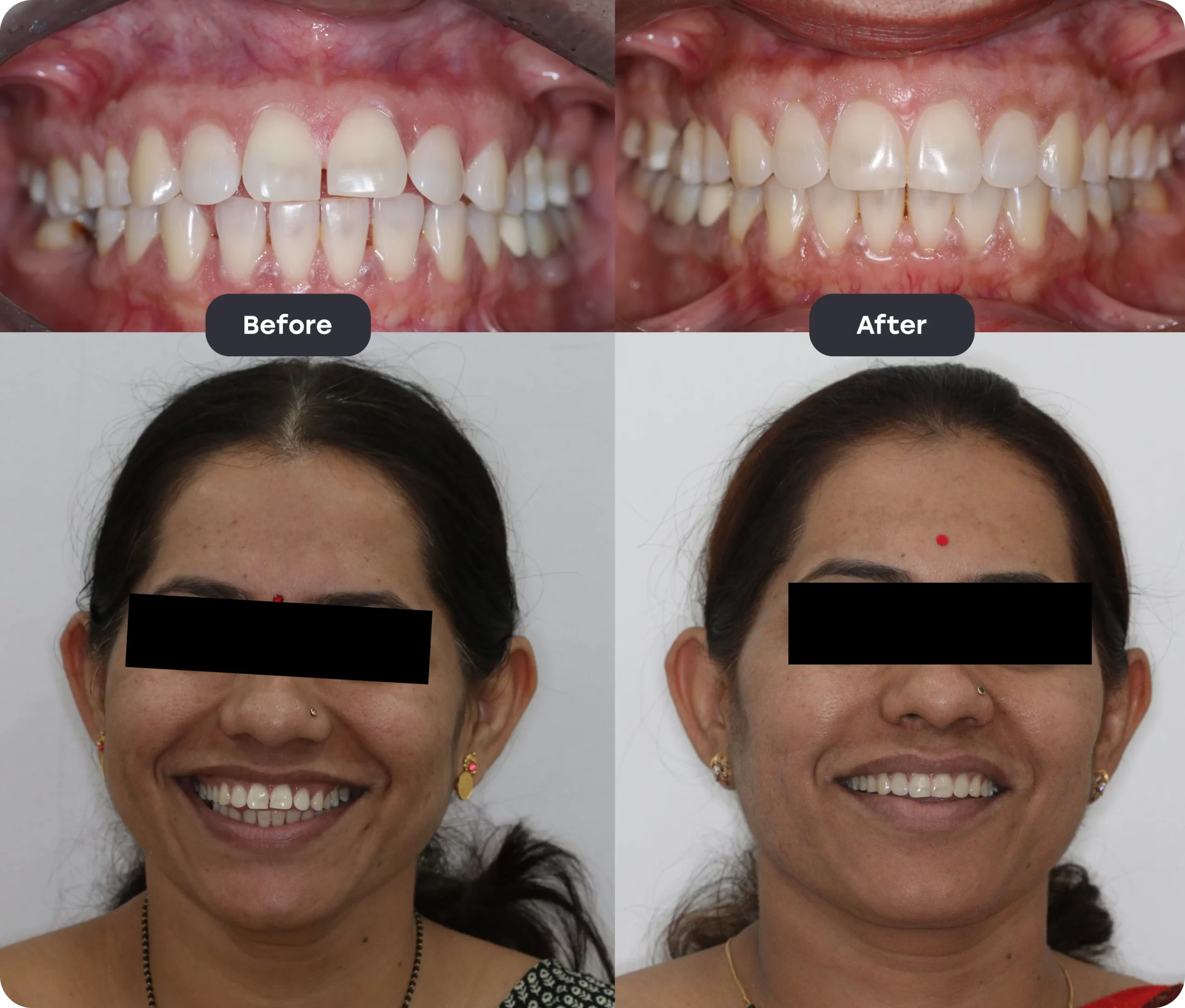 Before and After