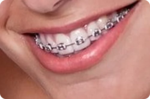 Orthodontic Treatment