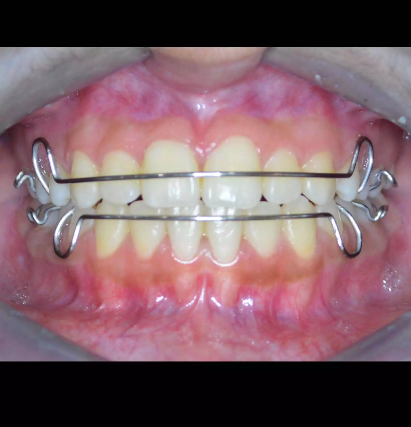Braces