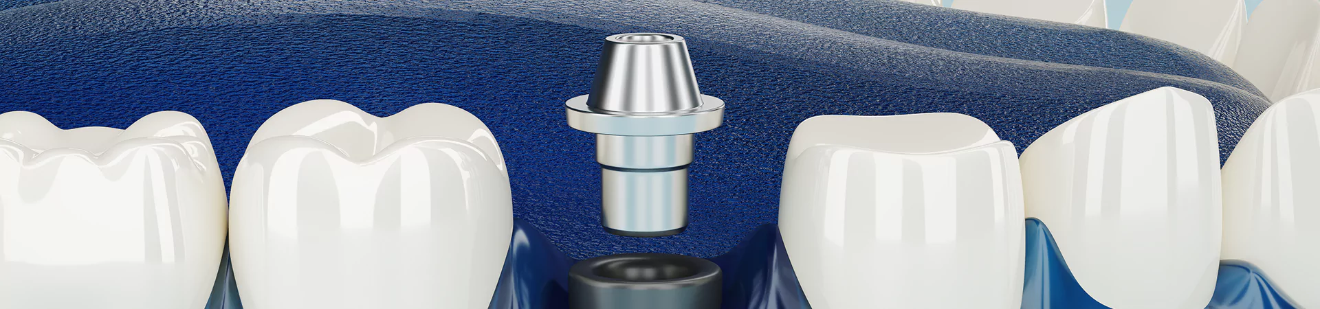 Single Tooth Implant