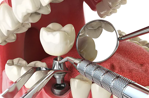Dental Implants