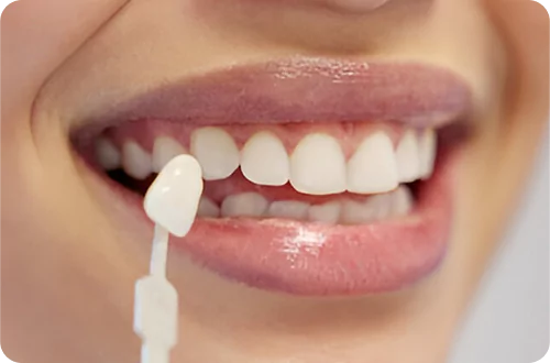 Smile Designing
