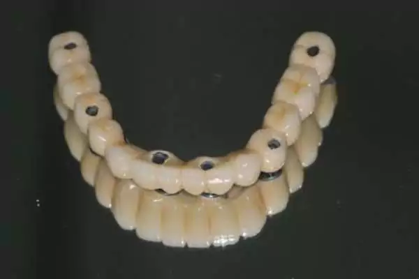 Dental Implants