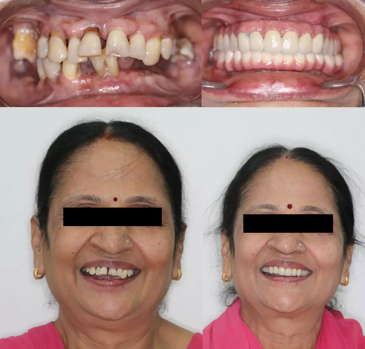 Fullmouth