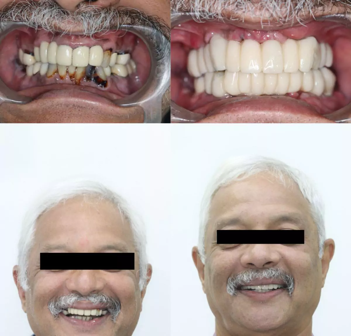 Fullmouth