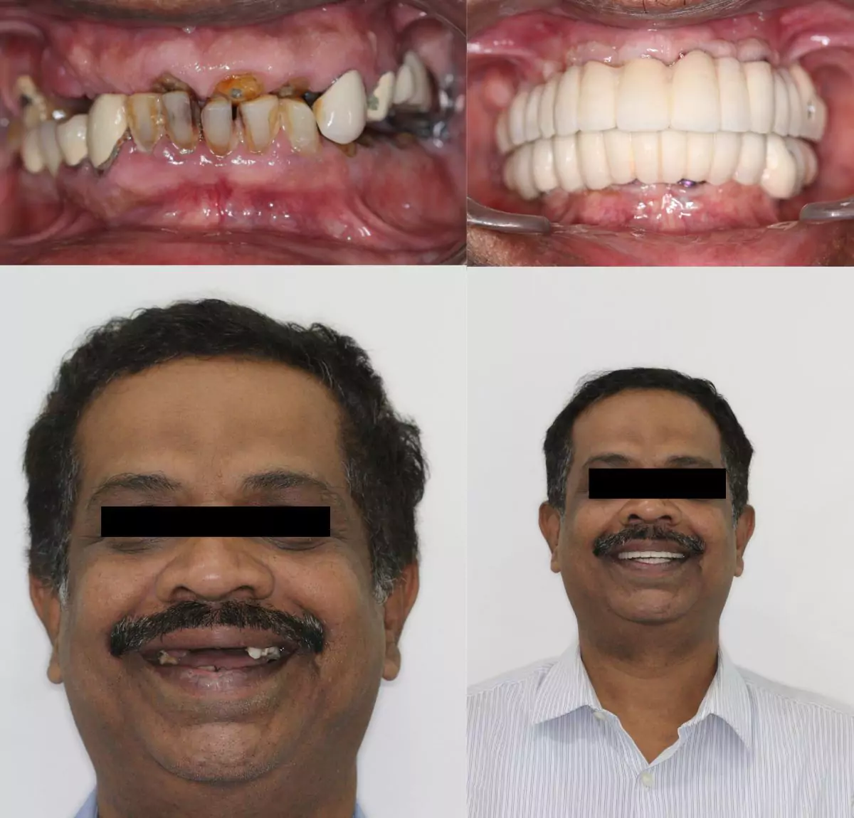 Fullmouth