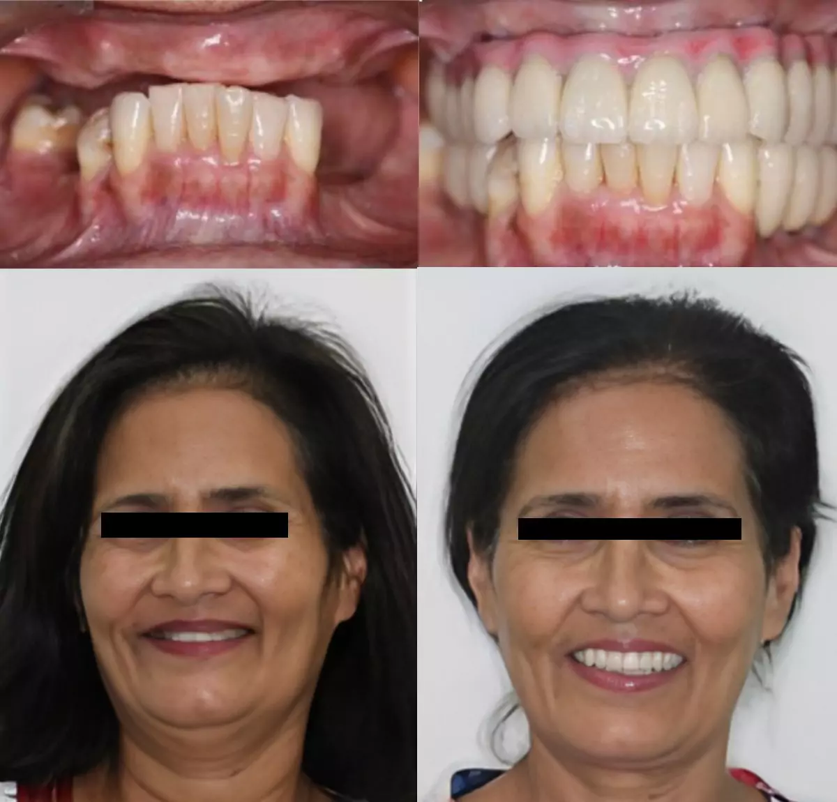 Fullmouth