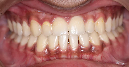 Pre Treatment