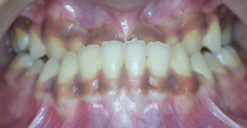 Pre Treatment