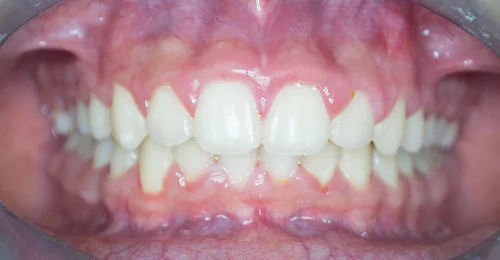 Pre Treatment