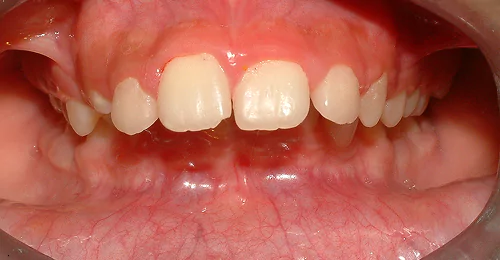 Pre Treatment