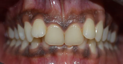 Pre Treatment