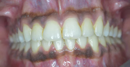 Pre Treatment