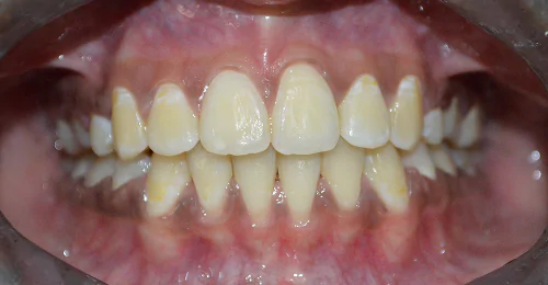 Pre Treatment