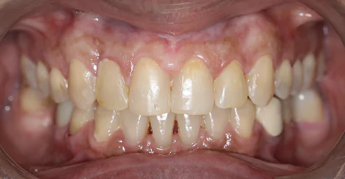 Post Treatment