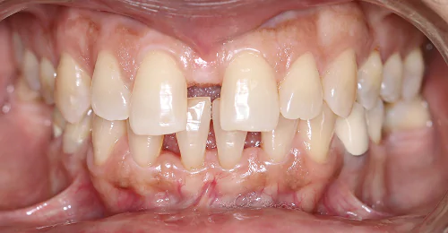 Pre Treatment