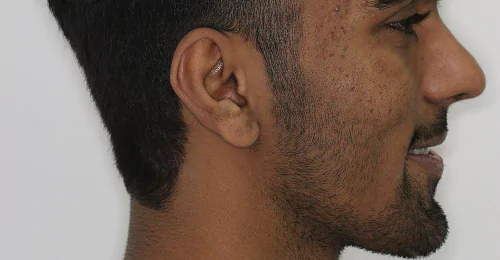 Post Treatment