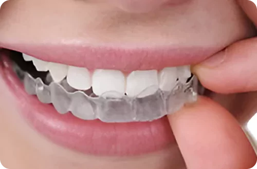Invisalign Aligner